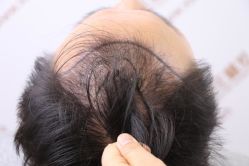 -新生植发·植养护一体