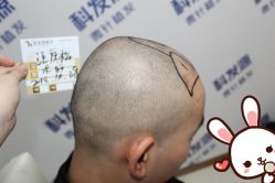 点击看大图 -大麦微针植发丨全国连锁