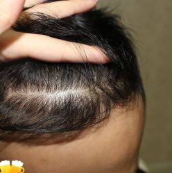 -大麦微针植发丨全国连锁