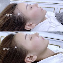 -OnFaer.纹眉半永久无创洗眉