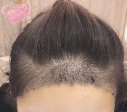 -大麦微针植发丨全国连锁