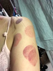 -苗塑堂减肥艾灸