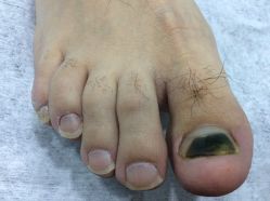 点击看大图 -德哥灰指甲脚气甲沟炎跖疣护理