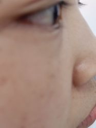 体验后-蕾特恩专业祛痘·皮肤管理