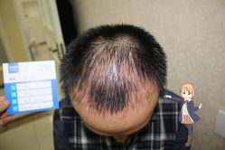 -大麦微针植发丨全国连锁