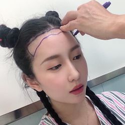 -碧莲盛·不剃发植发