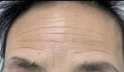 体验前-深圳美莱医疗美容医院