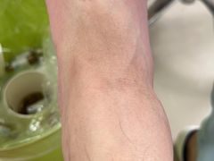 -乐泰亮甲灰指甲(龙城店)