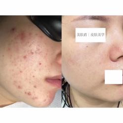 -美肤盾祛痘·问题肌头疗管理中心