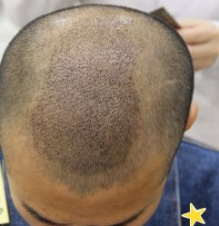 -大麦微针植发丨全国连锁