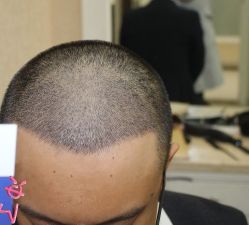 -大麦微针植发丨全国连锁