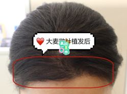 -大麦微针植发全国连锁