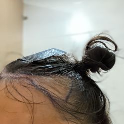 -碧莲盛·不剃发植发