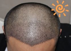 -大麦微针植发丨全国连锁