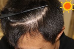 -大麦微针植发丨全国连锁