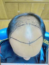 -大麦微针植发全国连锁