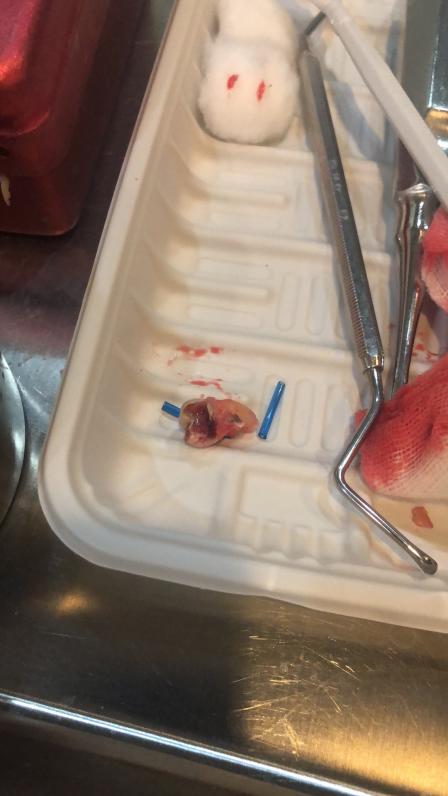 项目拔牙智齿疼痛难忍从小又怕看牙科在大众点评上看到了盛主任的患者