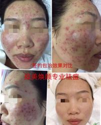 -美肤盾祛痘·问题肌头疗管理中心