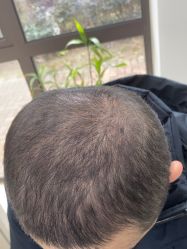 -大麦微针植发丨全国连锁