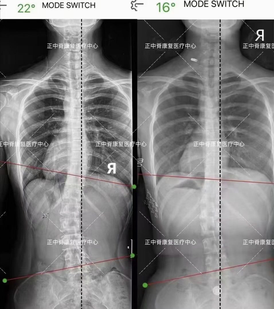 成长轨迹:骨骼x光对比
