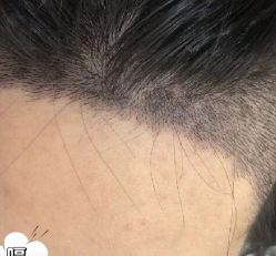 -大麦微针植发丨全国连锁