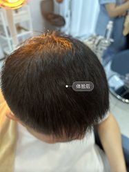 -大麦微针植发丨全国连锁
