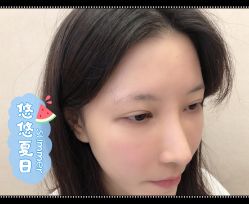 -大麦微针植发全国连锁