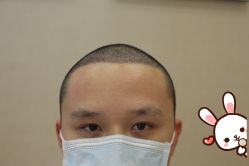 -大麦微针植发丨全国连锁