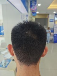 -大麦微针植发全国连锁