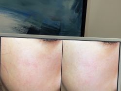 体验后-苑苑vbeauty科技美容SPA