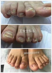 -德哥灰指甲脚气甲沟炎跖疣护理