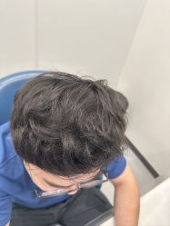 体验后-大麦微针植发全国连锁