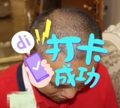 -大麦微针植发全国连锁