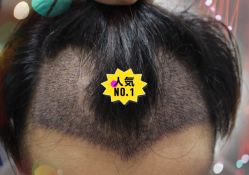 -大麦微针植发全国连锁