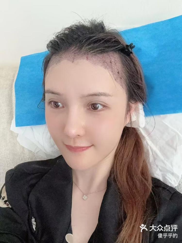 刘海怎么植发(刘海怎么植发好看)