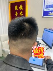 体验前-大麦微针植发全国连锁