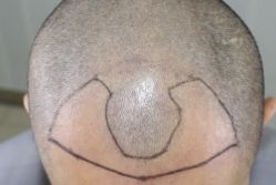 -大麦微针植发丨全国连锁