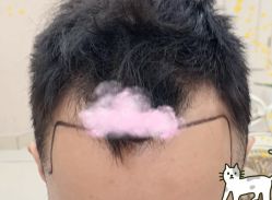 -大麦微针植发全国连锁