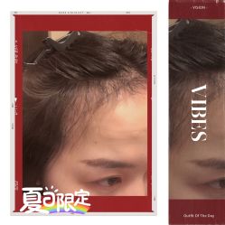 -大麦微针植发全国连锁