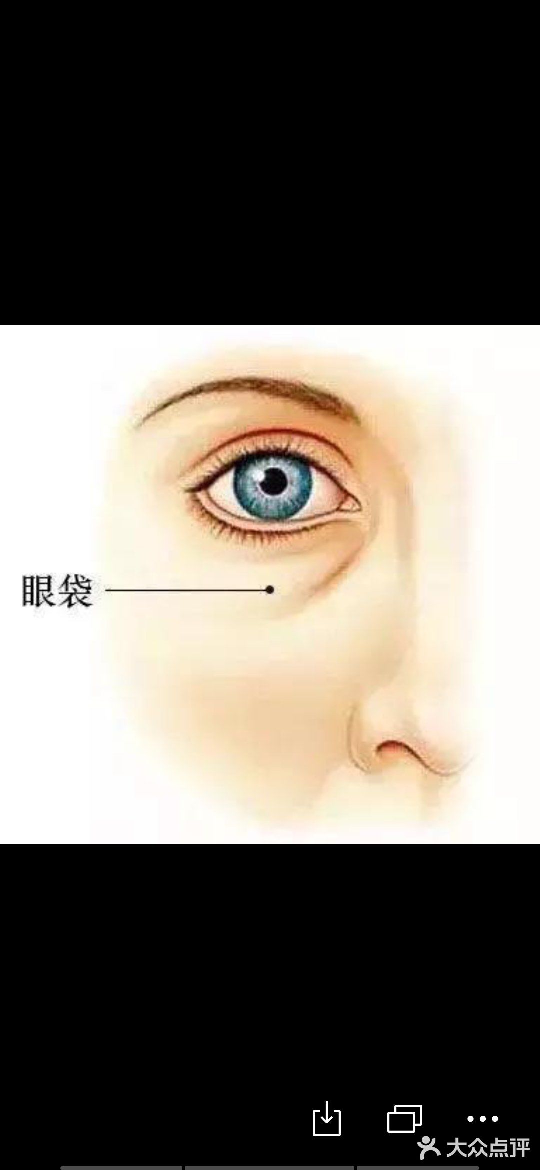 眼球就会下垂，这样就会把眼睛下面的脂肪向外挤压
