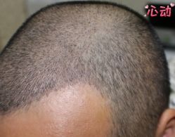 -大麦微针植发丨全国连锁