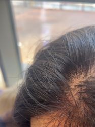 -碧莲盛·不剃发植发