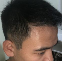 -碧莲盛·不剃发植发