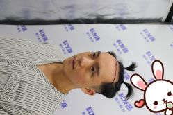 点击看大图 -大麦微针植发丨全国连锁