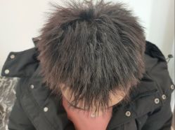 体验后-熙朵美学植发·连锁品牌