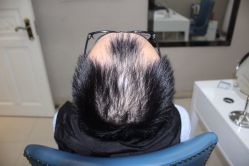 -大麦微针植发全国连锁