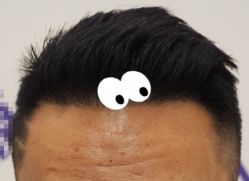 -大麦微针植发全国连锁