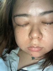 -爱莎扁平疣·汗管瘤·斑痣中心