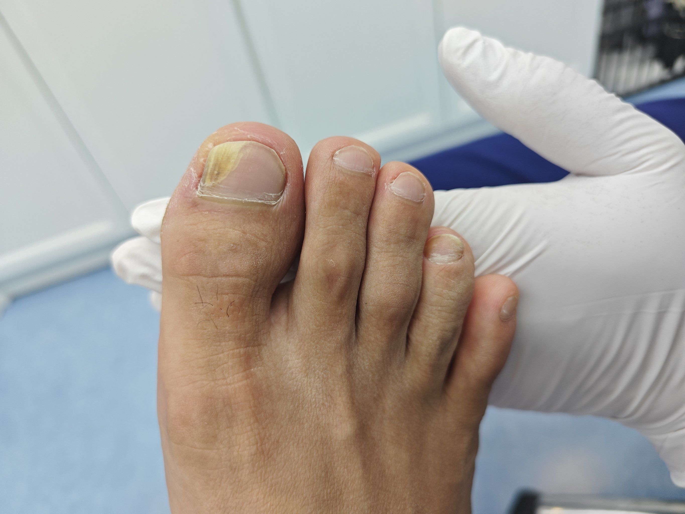 长期以来,我的灰指甲问题一直困扰着我,而