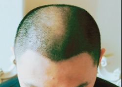 -大麦微针植发丨全国连锁